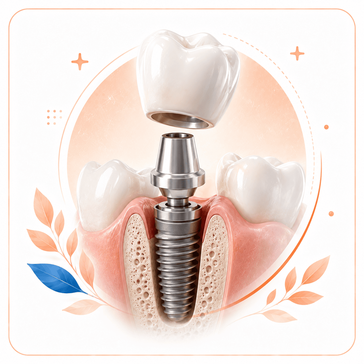Dental Implant